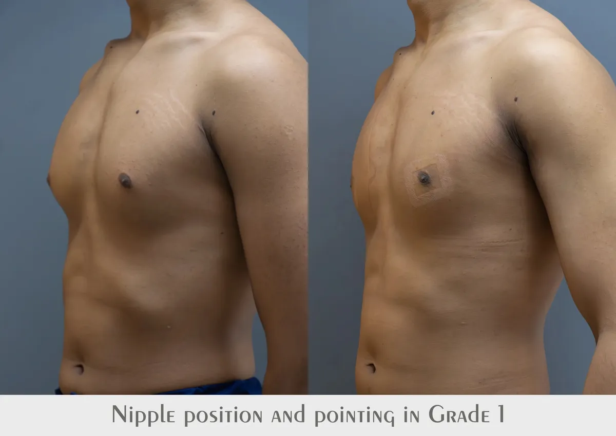 Gynecomastia (Male Breast Reduction) surgery results showing natural-looking aesthetic refinement by Dr. Sumit Singh Gautam in Chandigarh