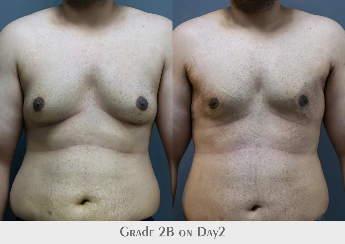 Gynecomastia (Male Breast Reduction) surgery results showing natural-looking aesthetic refinement by Dr. Sumit Singh Gautam in Chandigarh