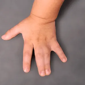 Hand Deformities