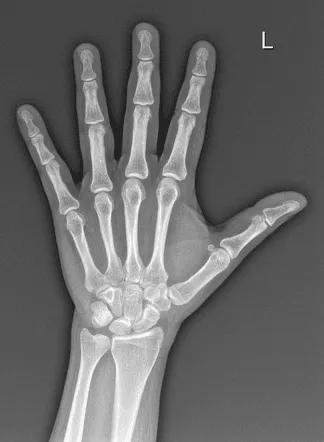 Fractures of Hand & Foot