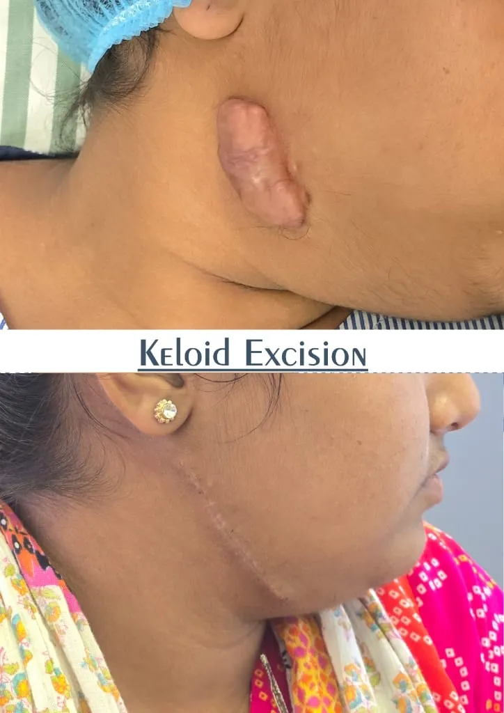 Scar Revision surgery results showing natural-looking aesthetic refinement by Dr. Sumit Singh Gautam in Chandigarh