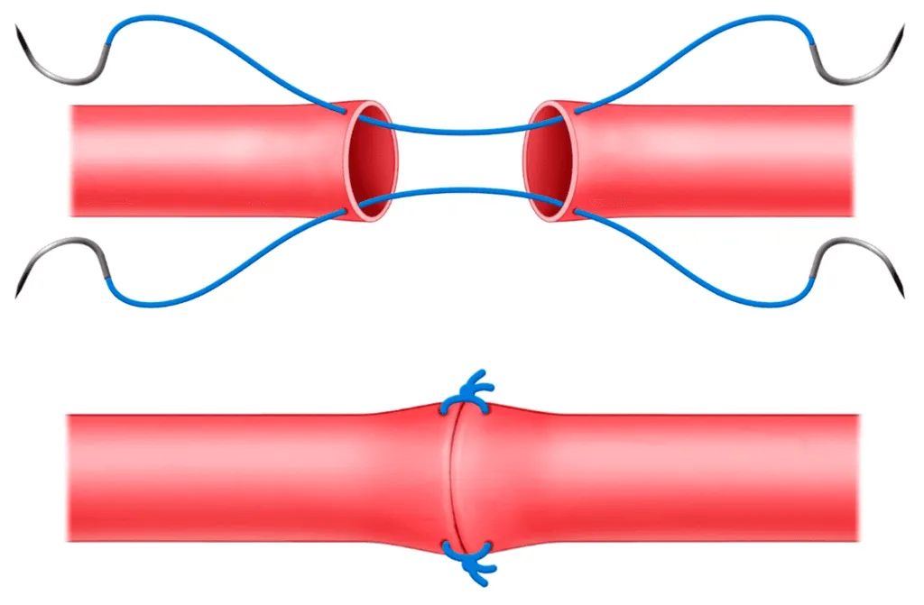 Microvascular Repair