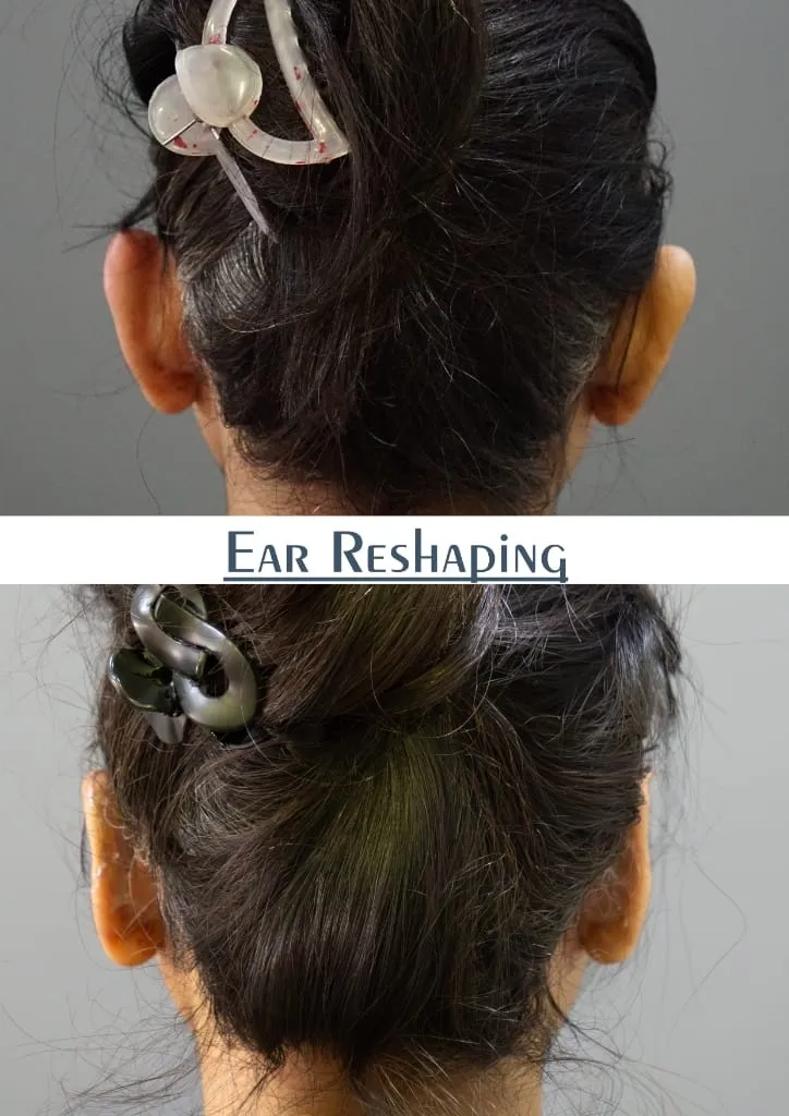 Ear Reshaping (Otoplasty) surgery results showing natural-looking aesthetic refinement by Dr. Sumit Singh Gautam in Chandigarh