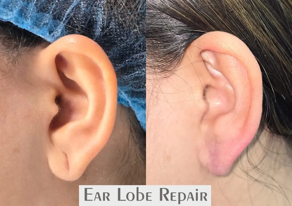 Ear Reshaping (Otoplasty) surgery results showing natural-looking aesthetic refinement by Dr. Sumit Singh Gautam in Chandigarh