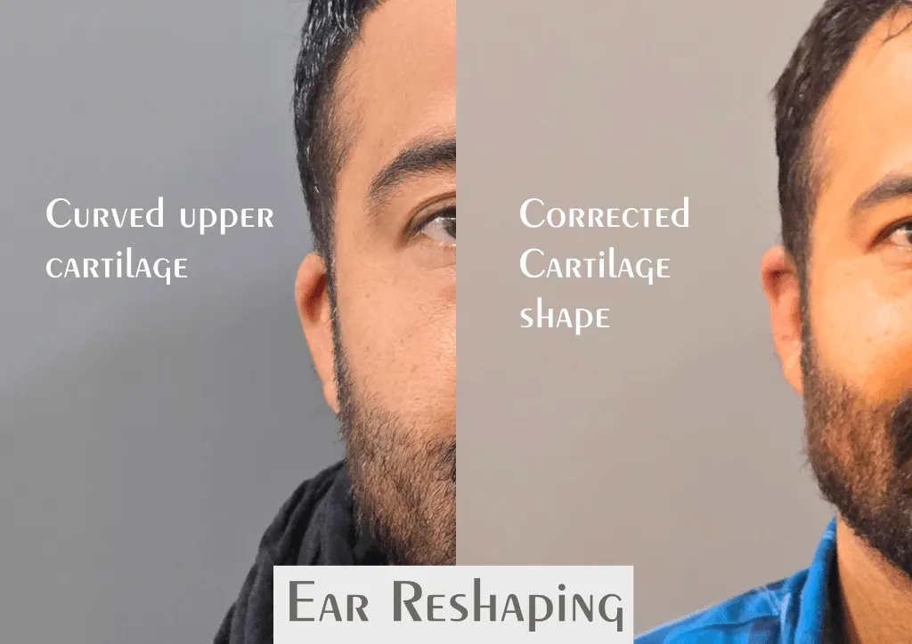 Ear Reshaping (Otoplasty) surgery results showing natural-looking aesthetic refinement by Dr. Sumit Singh Gautam in Chandigarh
