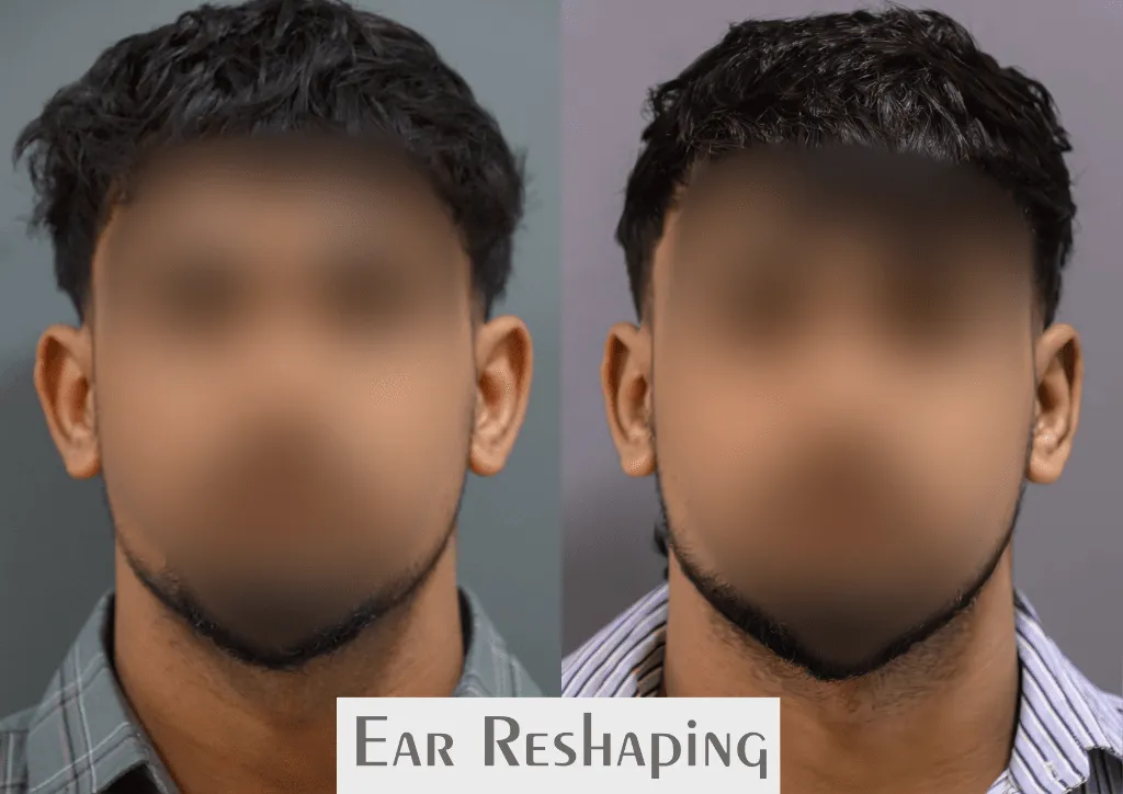 Ear Reshaping (Otoplasty) surgery results showing natural-looking aesthetic refinement by Dr. Sumit Singh Gautam in Chandigarh