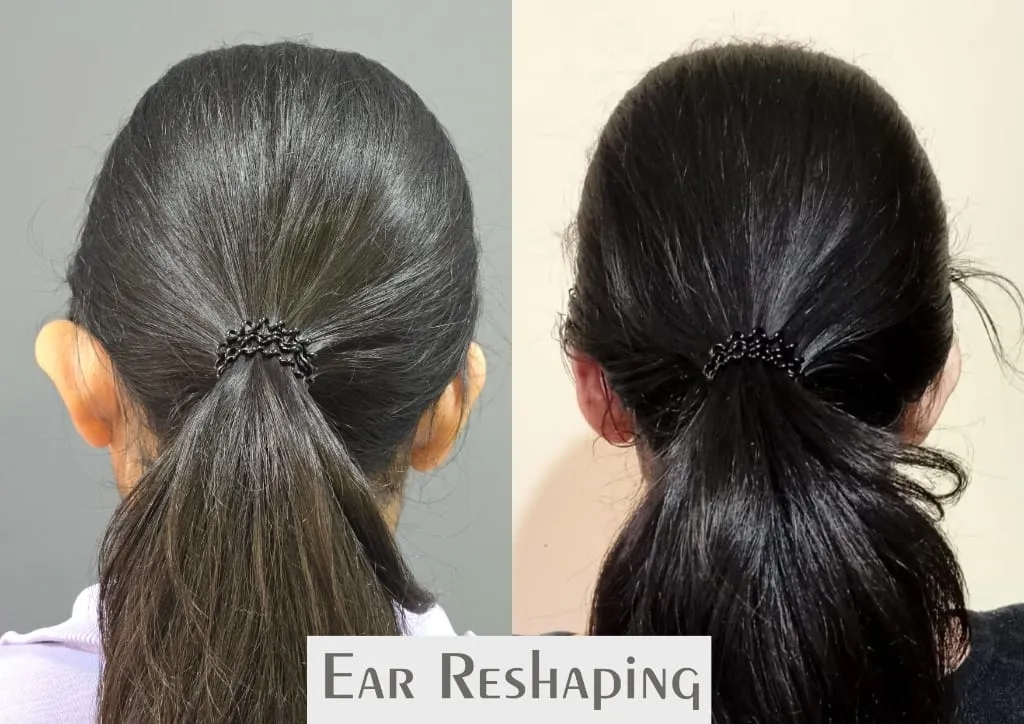 Ear Reshaping (Otoplasty) surgery results showing natural-looking aesthetic refinement by Dr. Sumit Singh Gautam in Chandigarh
