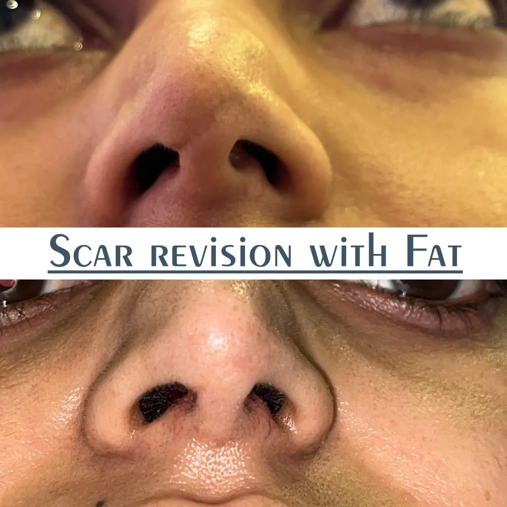 Scar Revision surgery results showing natural-looking aesthetic refinement by Dr. Sumit Singh Gautam in Chandigarh