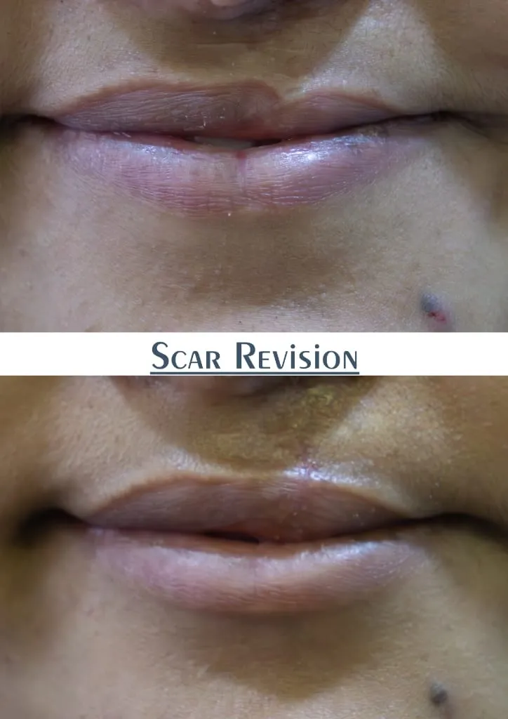 Scar Revision surgery results showing natural-looking aesthetic refinement by Dr. Sumit Singh Gautam in Chandigarh