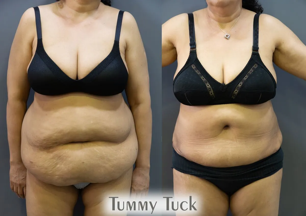 Body Contouring surgery results showing natural-looking aesthetic refinement by Dr. Sumit Singh Gautam in Chandigarh