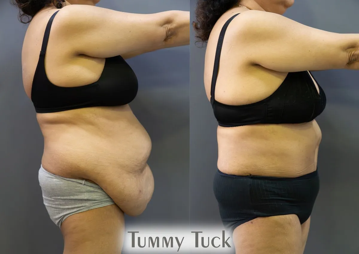 Body Contouring surgery results showing natural-looking aesthetic refinement by Dr. Sumit Singh Gautam in Chandigarh