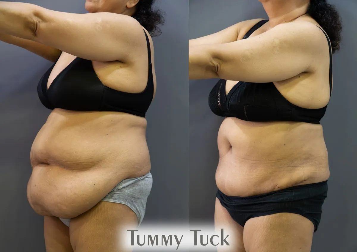 Body Contouring surgery results showing natural-looking aesthetic refinement by Dr. Sumit Singh Gautam in Chandigarh
