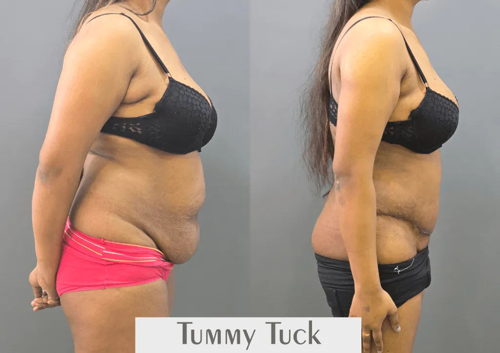 Body Contouring surgery results showing natural-looking aesthetic refinement by Dr. Sumit Singh Gautam in Chandigarh